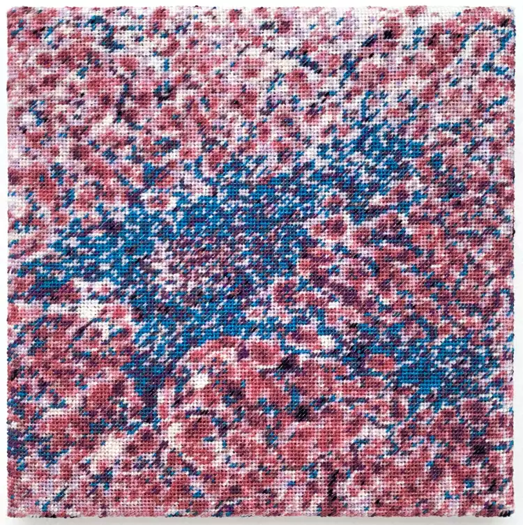 Continental stitch embroidery. Masson trichrome stain of a liver biopsy from a patient with primary biliary cholangitis. 20 × 20 cm