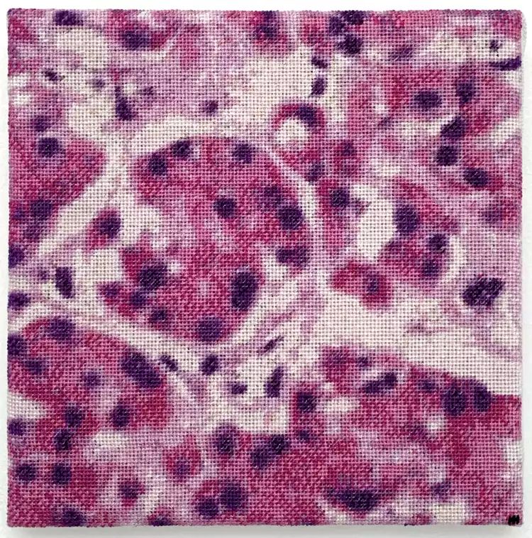 Continental stitch embroidery. Representation of oncocytic cells with abundant granular eosinophilic cytoplasm, in an oncocytoma. 20 × 20 cm