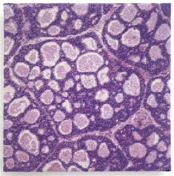 Adenoid Cystic Carcinoma