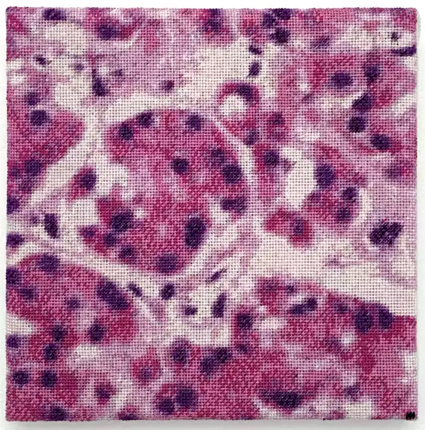 Oncocytic Cells